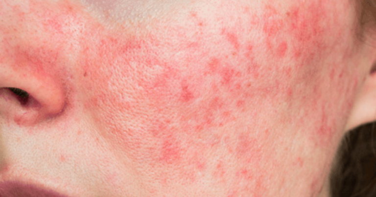 Can Urgent Care Treat a Skin Infection?