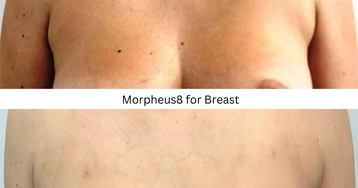 Morpheus8 for Breast Rejuvenation