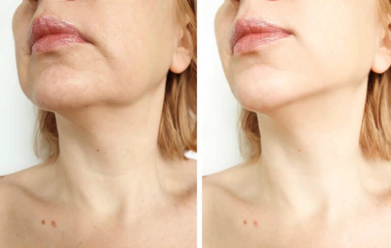 Skin Tightening Morpheus8 Before And After Pictures