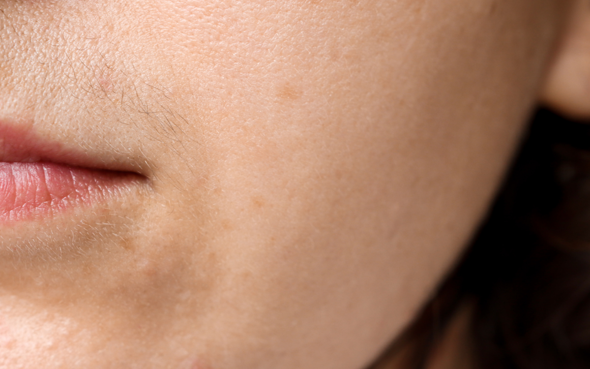 Melasma - skin above the upper lip