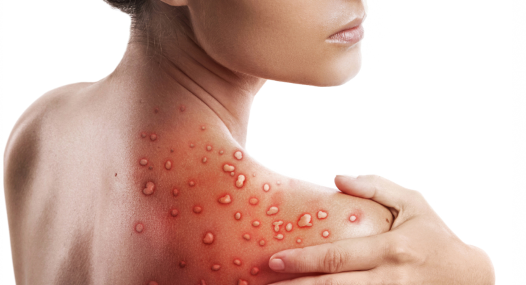What Skin Diseases Are Contagious?