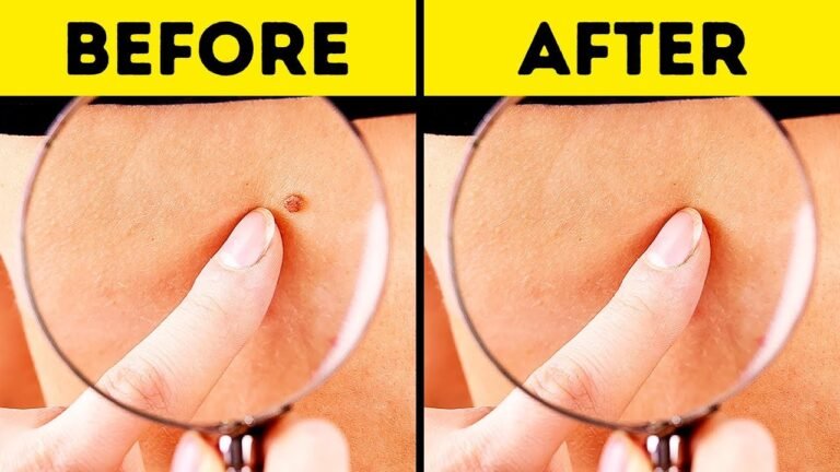 How to Remove Skin Tags in One Night?