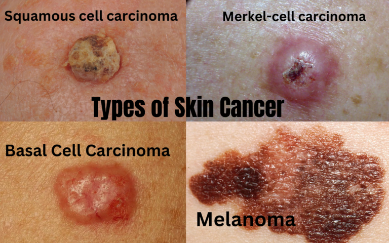 Unveiling Different Types of Skin Cancer