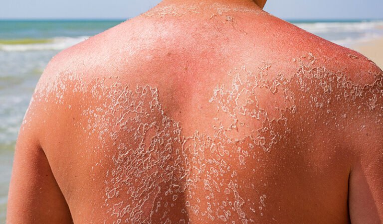 Why Is My Skin Peeling? Common Causes & Effective Solutions